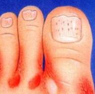 Le champignon sur les jambes