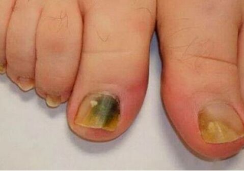 L'infection affecte les plaques d'ongle