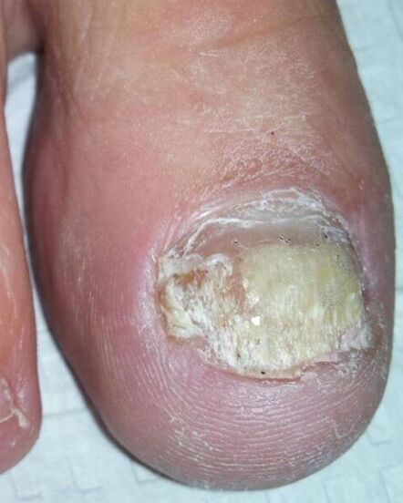 Le champignon sur les jambes