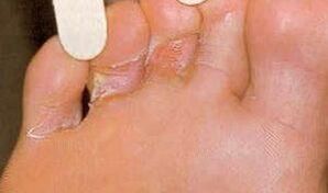 Lésions de dermaid pour la mycose du pied