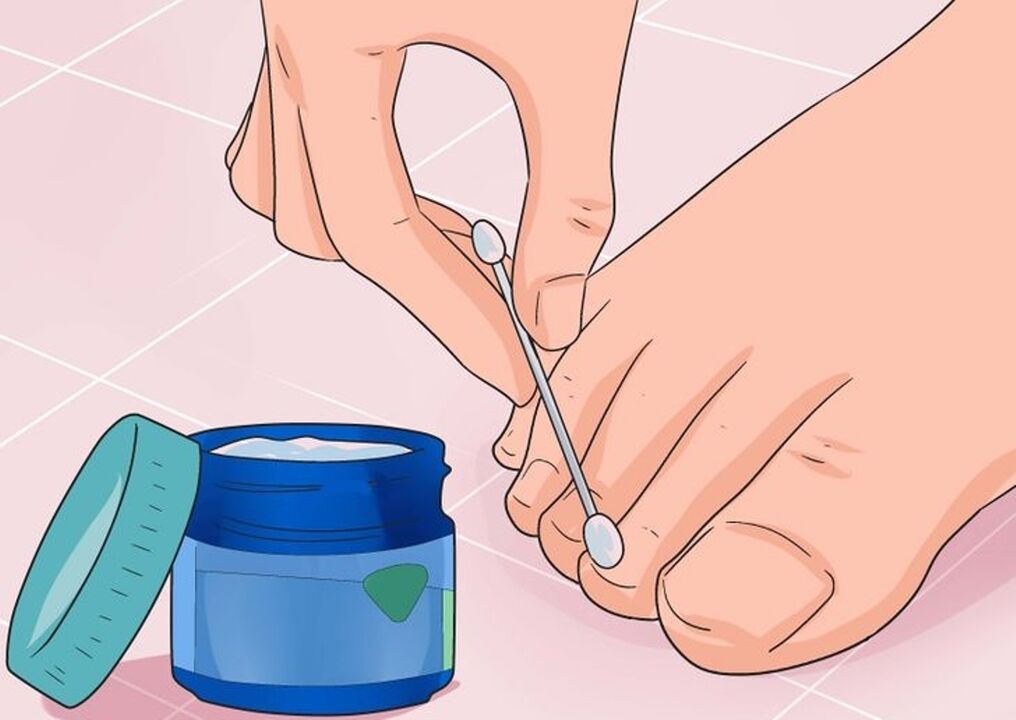 Cure Fungus Nail