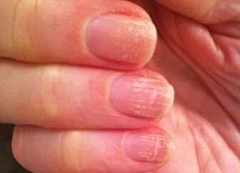 L'étape initiale du champignon sur les ongles