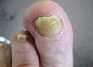 Les causes de l'apparence du champignon sur les ongles