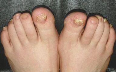 Signes de champignon sur les ongles