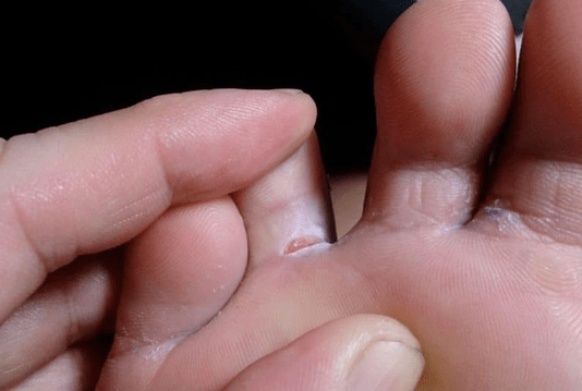 L'apparition de formations de bulles sur les pieds