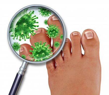 infection fongique des pieds