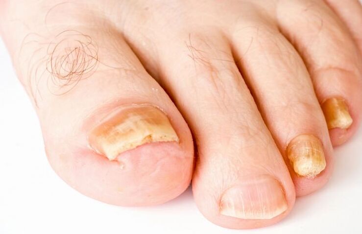 ongles jaunes à cause de champignons